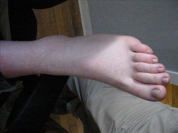Swollen Ankle