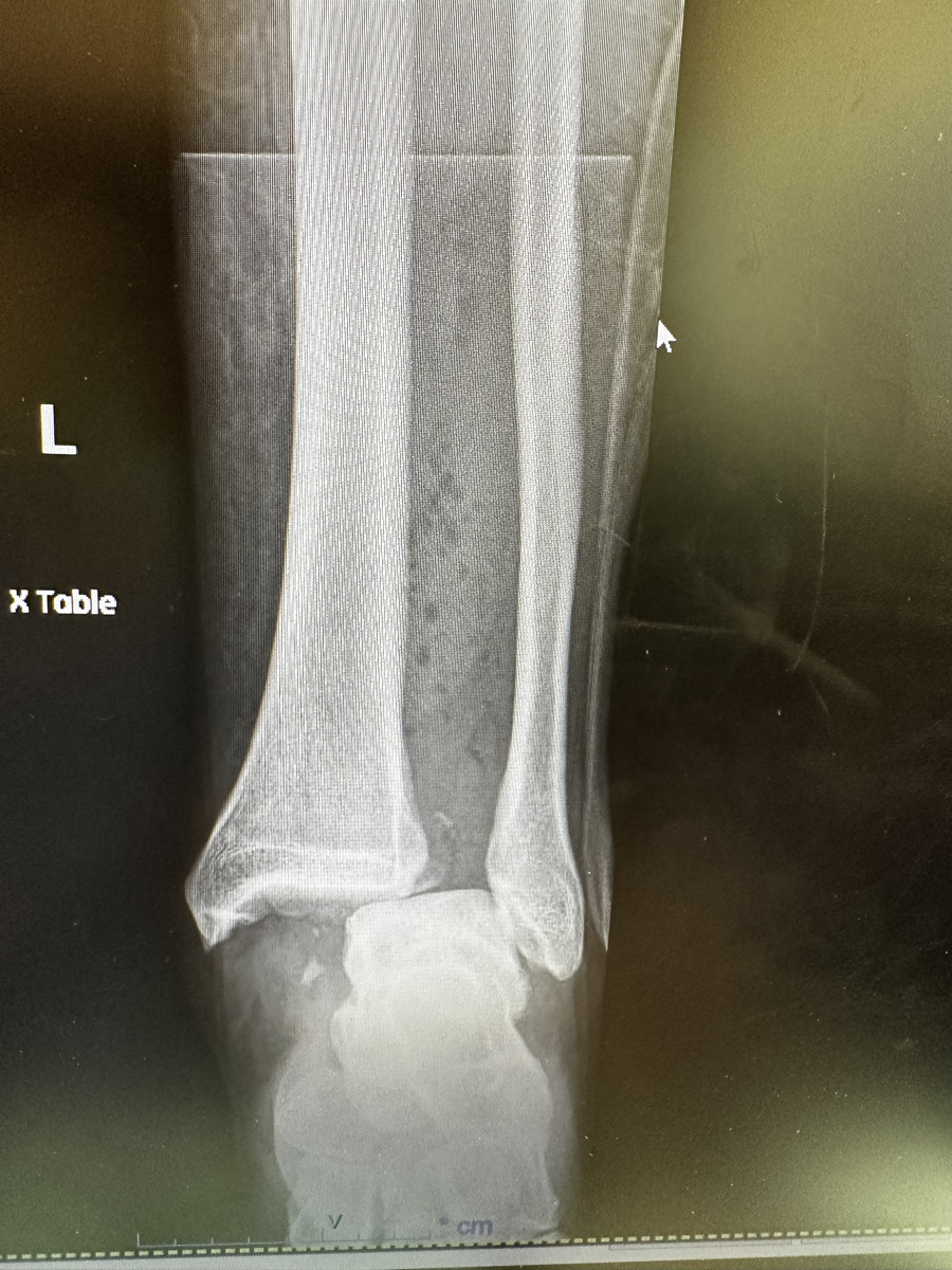 X-Ray of a fractured ankle.