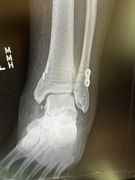X-Ray of a fractured ankle with hardware installed.